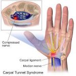 arthritis knee pain