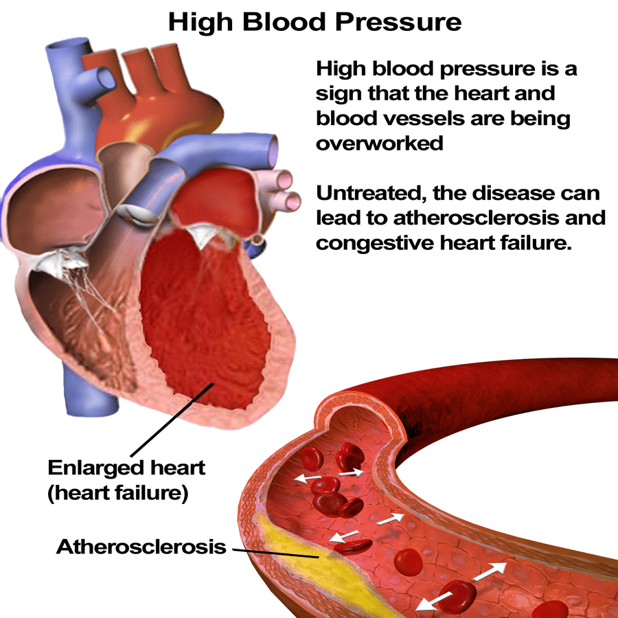 hypertension symptoms treatment