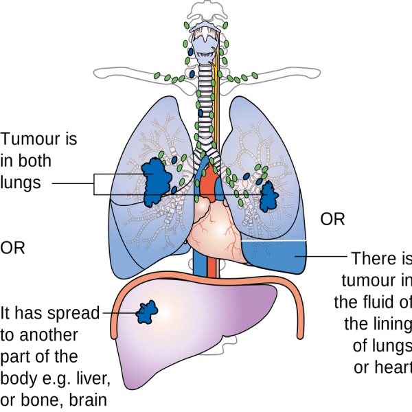A Look At Smoking Effects On The Lungs A Hypnotherapy Perspective