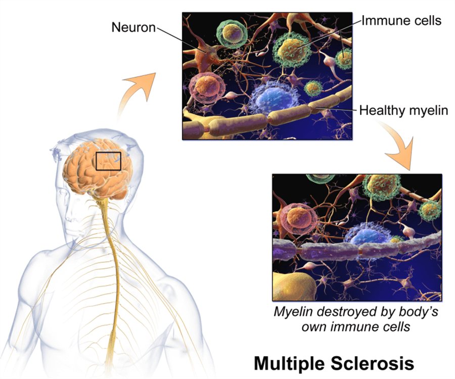 multiple sclerosis symptoms