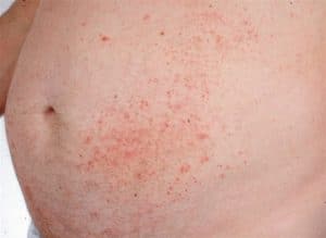 how long does contact dermatitis last