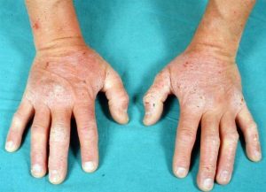 seborrheic dermatitis treatments