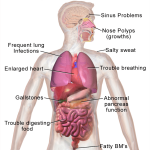 cystic fibrosis symptoms