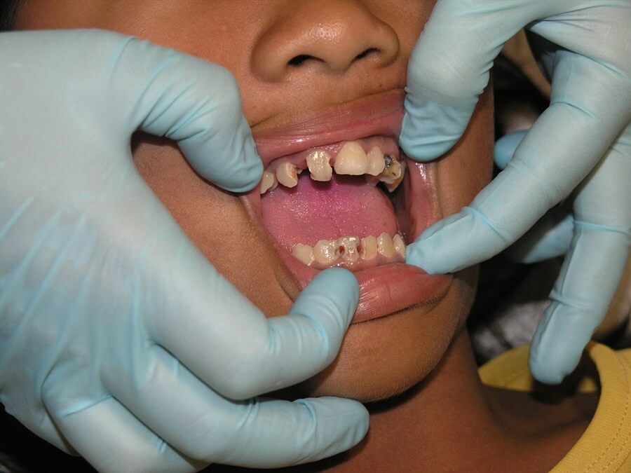fear of dentist bad teeth